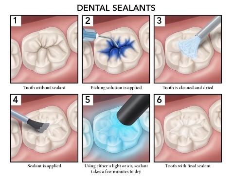 dental-sealants 2